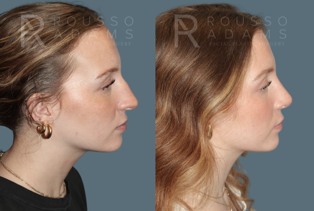 Rhinoplasty Before & After Gallery - Patient 318039 - Image 1