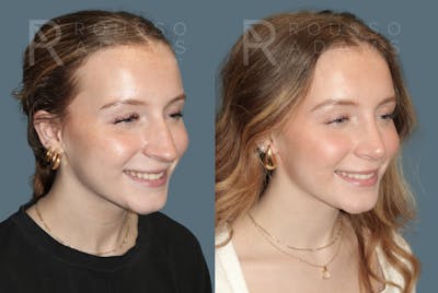 Rhinoplasty Before & After Gallery - Patient 318039 - Image 2