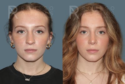Rhinoplasty <span class=small>By Dr. Daniel Rousso</span> Before & After Gallery - Patient 318039 - Image 1