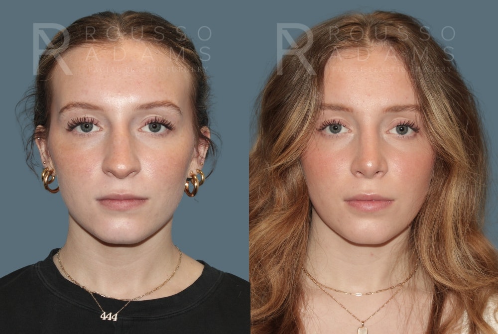 Rhinoplasty Before & After Gallery - Patient 318039 - Image 3