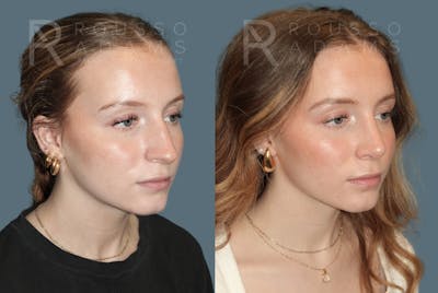 Rhinoplasty Before & After Gallery - Patient 318039 - Image 4