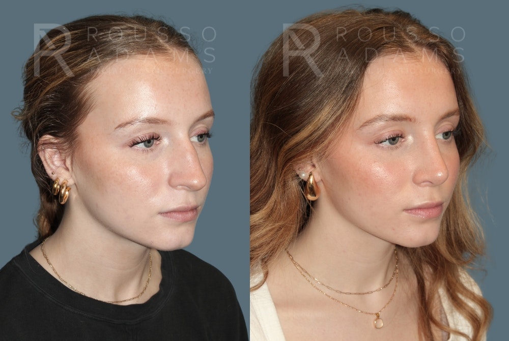 Rhinoplasty Before & After Gallery - Patient 318039 - Image 4