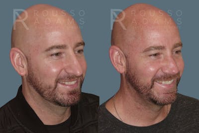 Rhinoplasty <span class=small>By Dr. Daniel Rousso</span> Before & After Gallery - Patient 148191 - Image 2