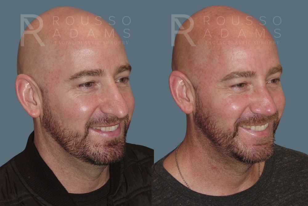 Rhinoplasty <span class=small>By Dr. Daniel Rousso</span> Before & After Gallery - Patient 148191 - Image 2