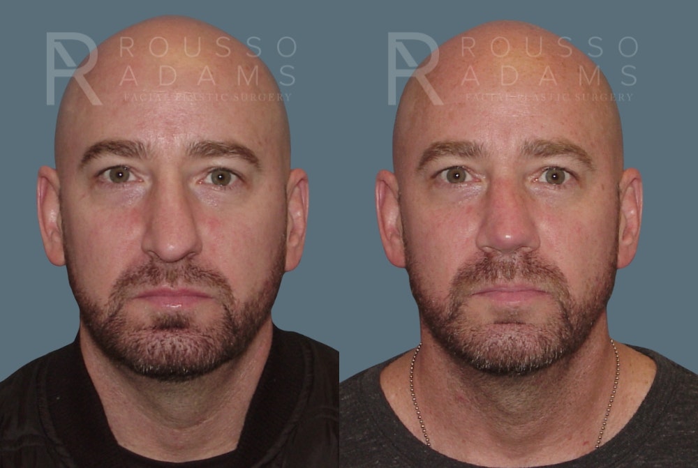 Rhinoplasty <span class=small>By Dr. Daniel Rousso</span> Before & After Gallery - Patient 148191 - Image 3
