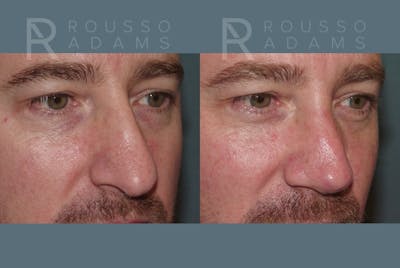 Rhinoplasty <span class=small>By Dr. Daniel Rousso</span> Before & After Gallery - Patient 148191 - Image 4