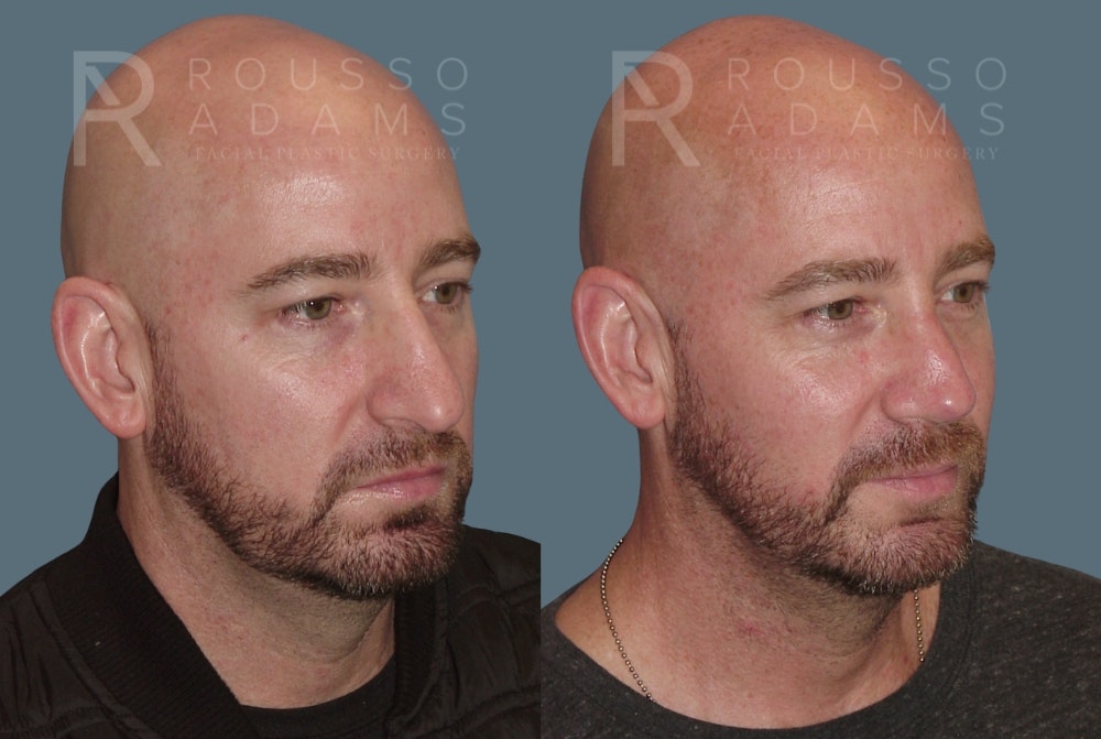 Rhinoplasty <span class=small>By Dr. Daniel Rousso</span> Before & After Gallery - Patient 148191 - Image 5
