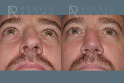 Rhinoplasty <span class=small>By Dr. Daniel Rousso</span> Before & After Gallery - Patient 148191 - Image 6