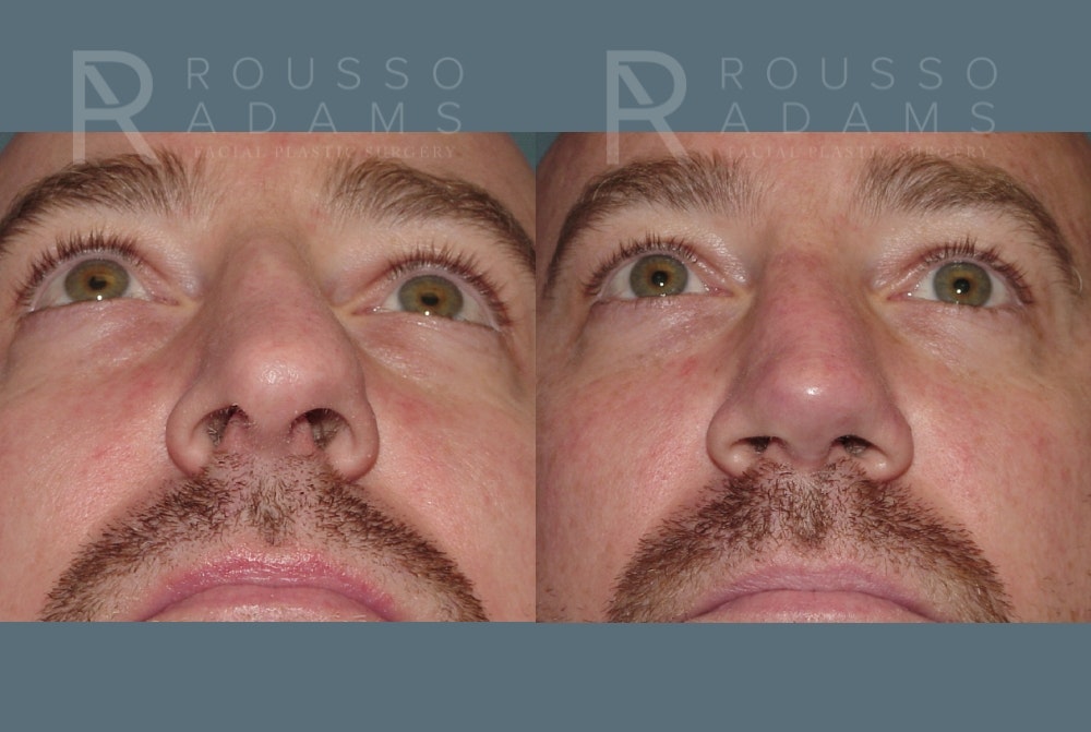 Rhinoplasty <span class=small>By Dr. Daniel Rousso</span> Before & After Gallery - Patient 148191 - Image 6