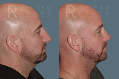 Rhinoplasty <span class=small>By Dr. Daniel Rousso</span> Before & After Gallery - Patient 148191 - Image 1