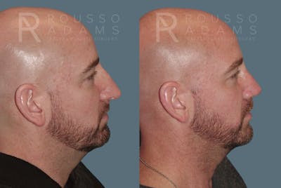 Rhinoplasty Before & After Gallery - Patient 148191 - Image 1