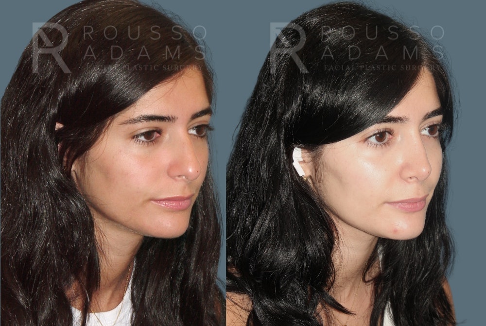 Rhinoplasty <span class=small>By Dr. Daniel Rousso</span> Before & After Gallery - Patient 466845 - Image 2