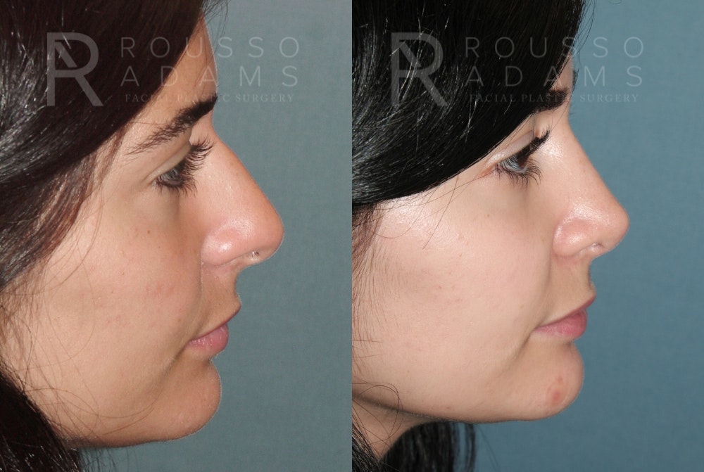 Rhinoplasty <span class=small>By Dr. Daniel Rousso</span> Before & After Gallery - Patient 466845 - Image 3