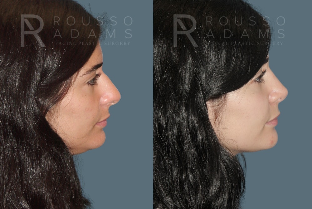 Rhinoplasty <span class=small>By Dr. Daniel Rousso</span> Before & After Gallery - Patient 466845 - Image 1