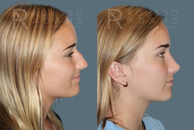 Rhinoplasty Before & After Gallery - Patient 933347 - Image 1