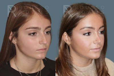 Rhinoplasty <span class=small>By Dr. Daniel Rousso</span> Before & After Gallery - Patient 764627 - Image 2