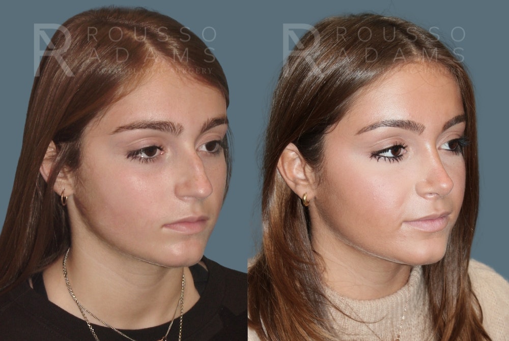 Rhinoplasty <span class=small>By Dr. Daniel Rousso</span> Before & After Gallery - Patient 764627 - Image 2