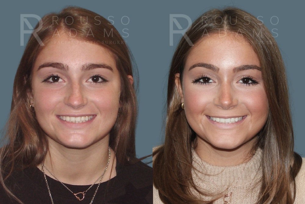 Rhinoplasty <span class=small>By Dr. Daniel Rousso</span> Before & After Gallery - Patient 764627 - Image 3
