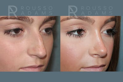 Rhinoplasty <span class=small>By Dr. Daniel Rousso</span> Before & After Gallery - Patient 764627 - Image 4