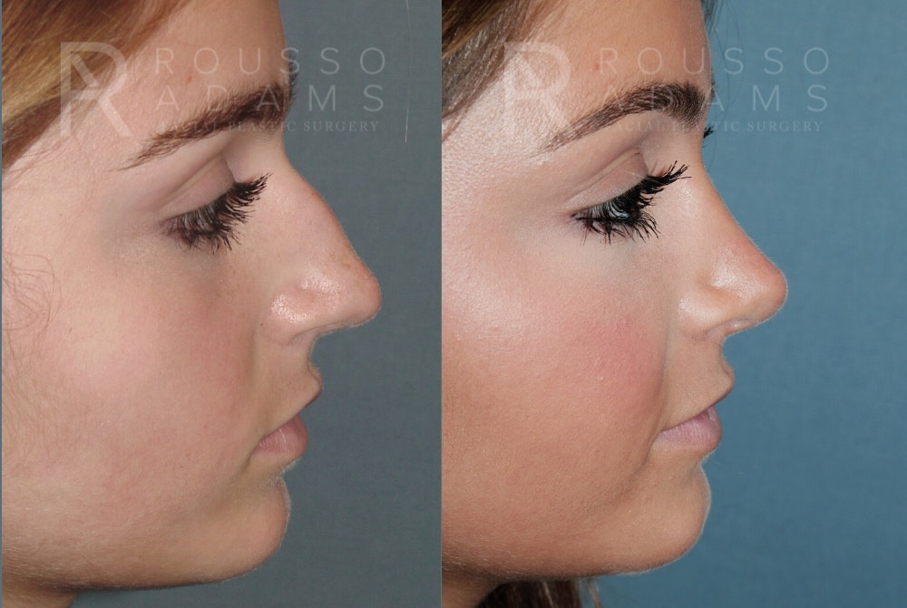 Rhinoplasty <span class=small>By Dr. Daniel Rousso</span> Before & After Gallery - Patient 764627 - Image 5