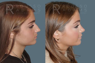 Rhinoplasty Before & After Gallery - Patient 764627 - Image 1