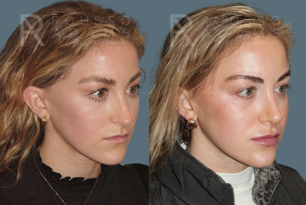 Rhinoplasty <span class=small>By Dr. Daniel Rousso</span> Before & After Gallery - Patient 320449 - Image 2
