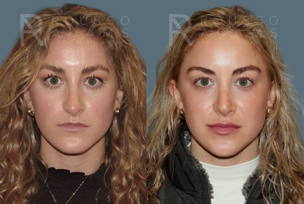 Rhinoplasty <span class=small>By Dr. Daniel Rousso</span> Before & After Gallery - Patient 320449 - Image 3