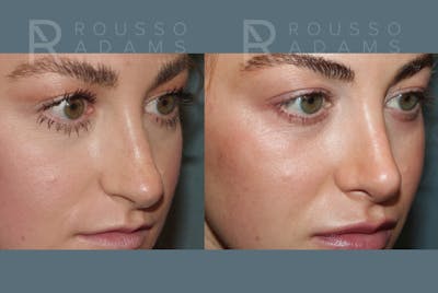 Rhinoplasty <span class=small>By Dr. Daniel Rousso</span> Before & After Gallery - Patient 320449 - Image 4