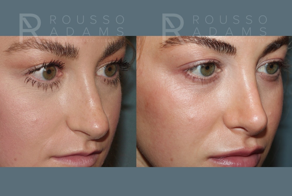 Rhinoplasty <span class=small>By Dr. Daniel Rousso</span> Before & After Gallery - Patient 320449 - Image 4