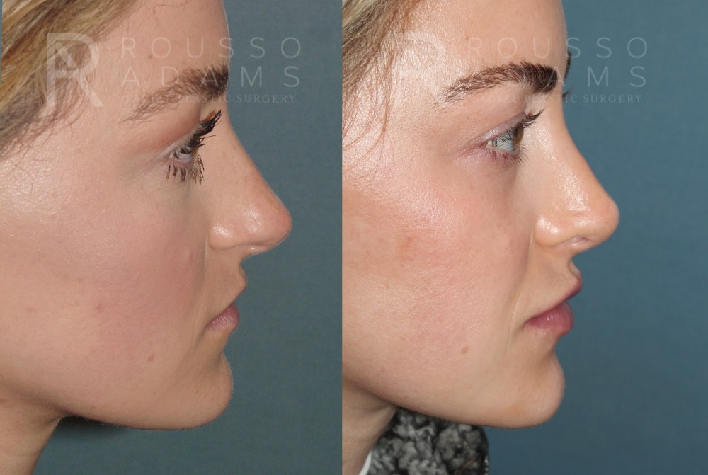 Rhinoplasty <span class=small>By Dr. Daniel Rousso</span> Before & After Gallery - Patient 320449 - Image 5