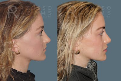 Rhinoplasty Before & After Gallery - Patient 320449 - Image 1
