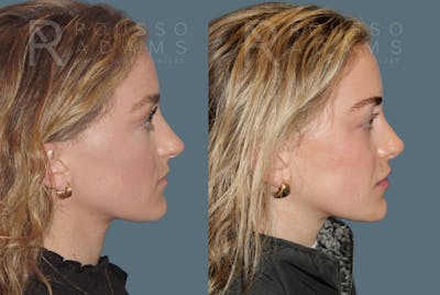 Rhinoplasty <span class=small>By Dr. Daniel Rousso</span> Before & After Gallery - Patient 320449 - Image 1