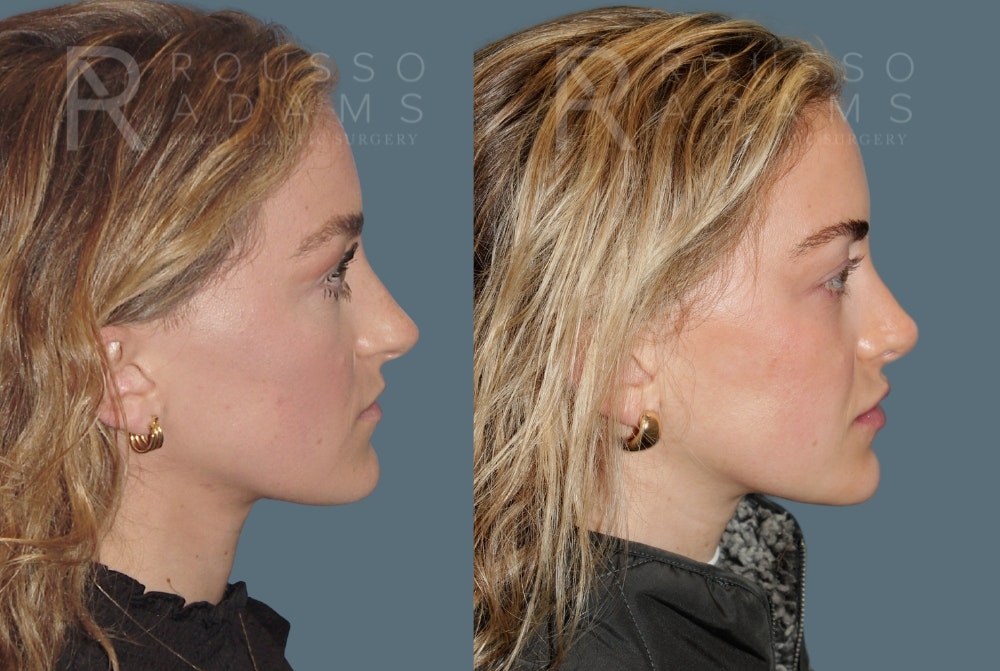 Rhinoplasty <span class=small>By Dr. Daniel Rousso</span> Before & After Gallery - Patient 320449 - Image 1