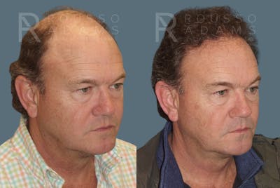 Hair Transplant Before & After Gallery - Patient 2574218 - Image 2