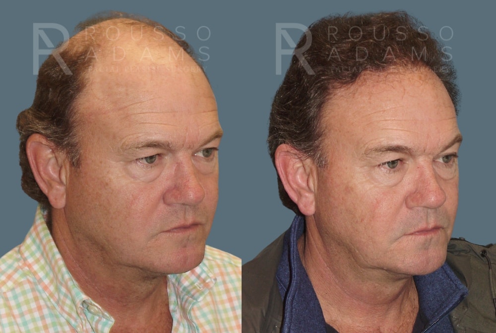 Hair Transplant Before & After Gallery - Patient 2574218 - Image 2