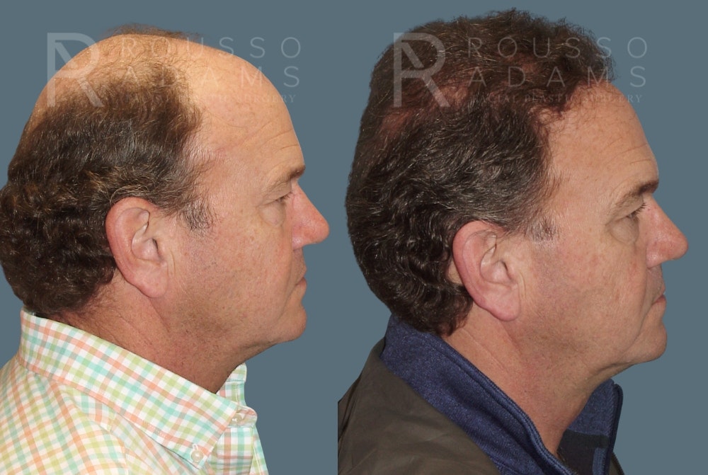 Hair Transplant Before & After Gallery - Patient 2574218 - Image 3