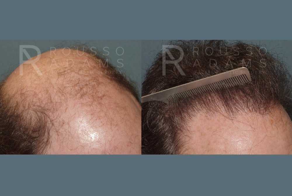 Hair Transplant Before & After Gallery - Patient 2574218 - Image 4