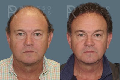 Hair Transplant Before & After Gallery - Patient 2574218 - Image 1