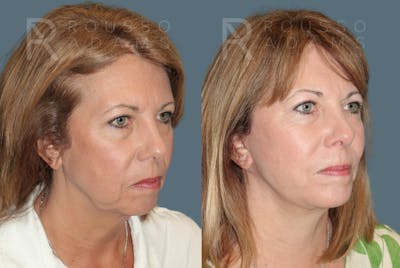 Facelift Before & After Gallery - Patient 296178 - Image 1
