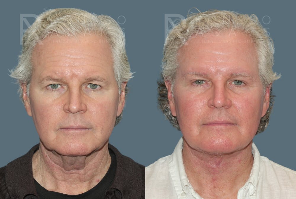 Before & After Image