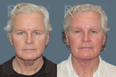 Male Facelift Before & After Gallery - Patient 224683 - Image 1