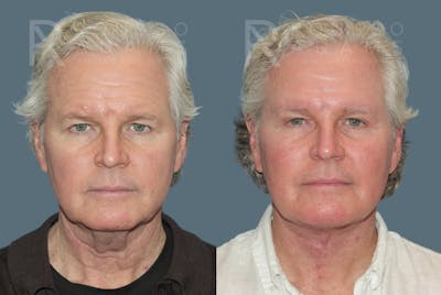 Male Facelift <span class=small>By Dr. Daniel Rousso</span> Before & After Gallery - Patient 224683 - Image 1