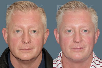 Blepharoplasty <span class=small>By Dr. Daniel Rousso</span> Before & After Gallery - Patient 144285 - Image 2