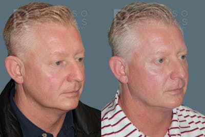 Acculift <span class=small>By Dr. Daniel Rousso</span> Before & After Gallery - Patient 427128 - Image 2