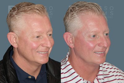 Acculift <span class=small>By Dr. Daniel Rousso</span> Before & After Gallery - Patient 427128 - Image 1