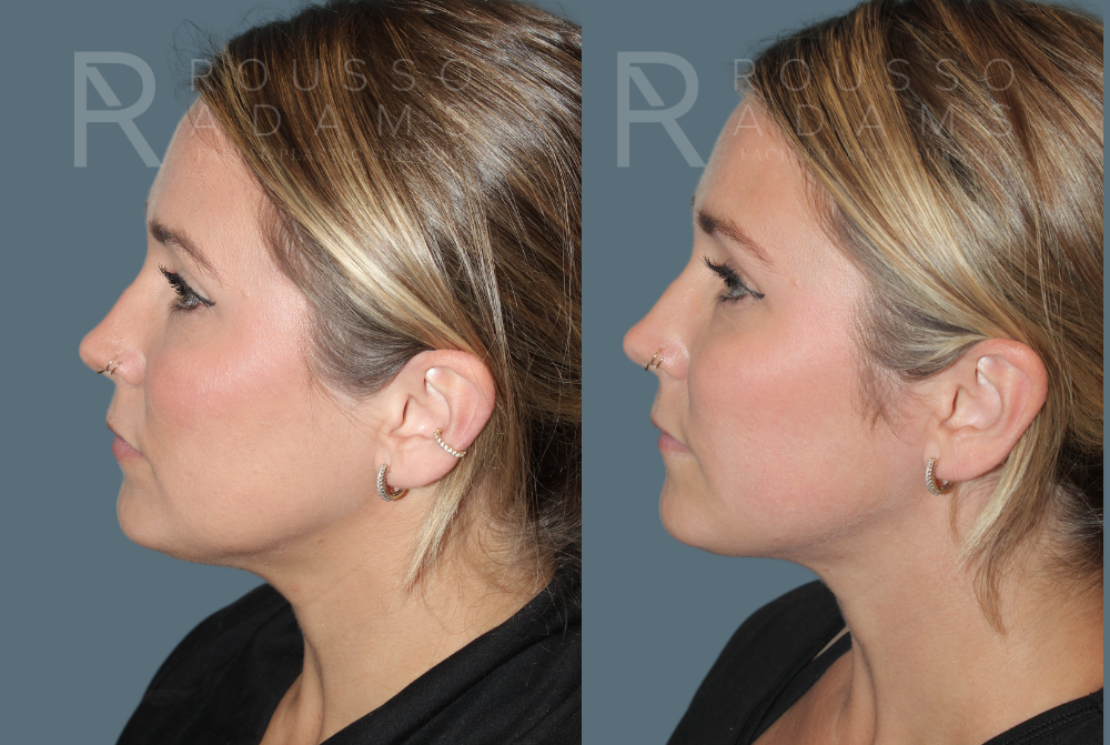 Acculift <span class=small>By Dr. Daniel Rousso</span> Before & After Gallery - Patient 232325 - Image 3