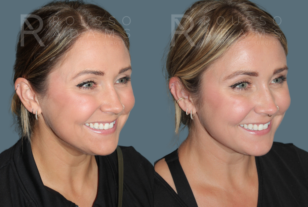 Acculift <span class=small>By Dr. Daniel Rousso</span> Before & After Gallery - Patient 232325 - Image 1