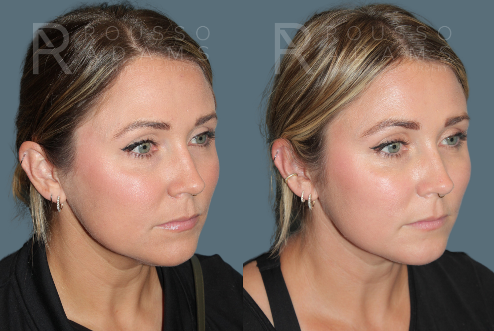 Acculift <span class=small>By Dr. Daniel Rousso</span> Before & After Gallery - Patient 232325 - Image 2