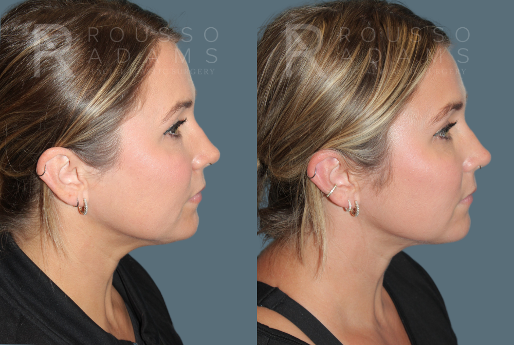 Acculift <span class=small>By Dr. Daniel Rousso</span> Before & After Gallery - Patient 232325 - Image 4