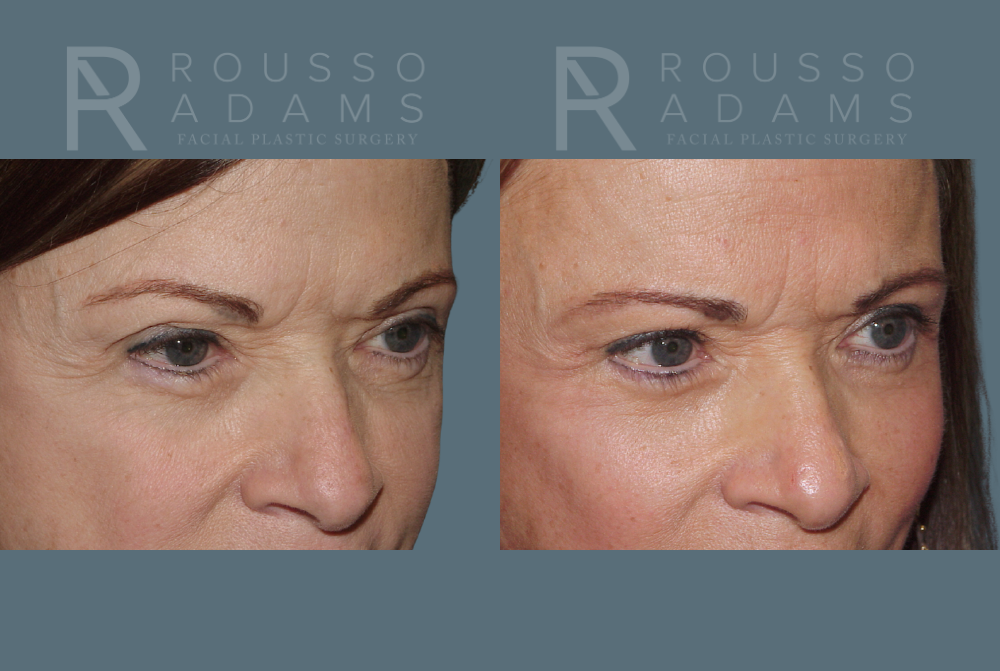 Blepharoplasty <span class=small>By Dr. Daniel Rousso</span> Before & After Gallery - Patient 610638 - Image 2